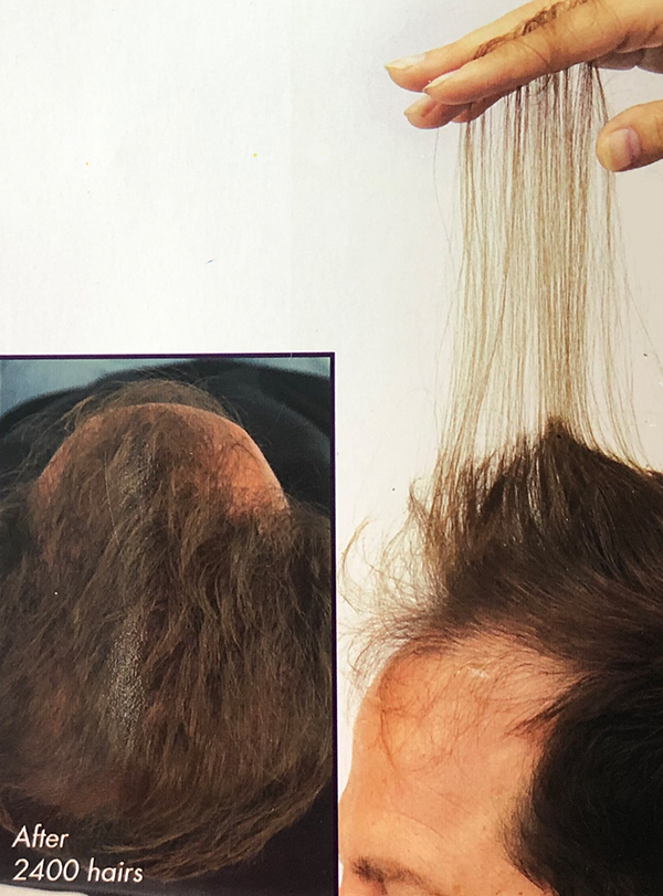 non-surgical hair replacement